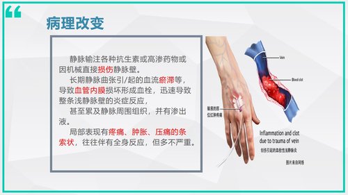 a0007 静脉炎的预防及处理_70675 第5页