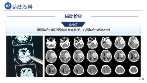 a0014 一例脑梗死患者的个案护理 第5页