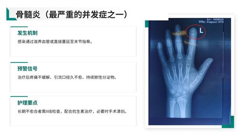 a0030 脓性指头炎护理查房带参考文献PPT37页可编辑无水印 第12页