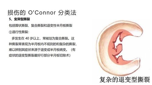 a0043 半月板损伤分型与治疗 第3页