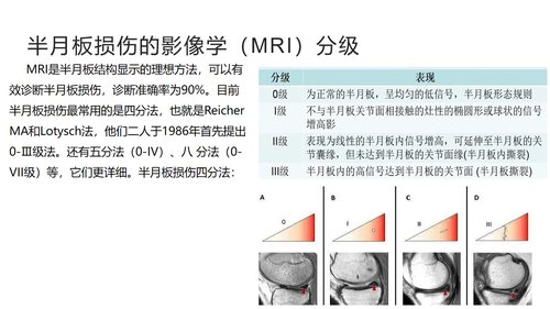 a0043 半月板损伤分型与治疗 第4页