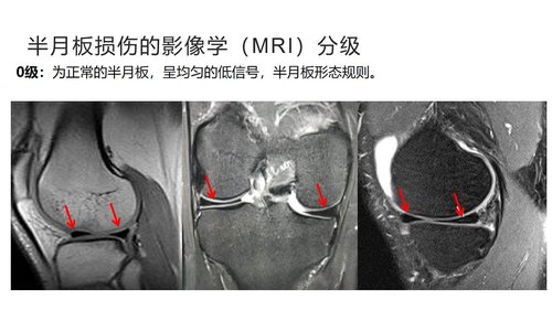 a0043 半月板损伤分型与治疗 第5页