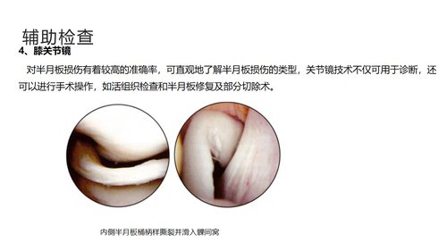 a0043 半月板损伤分型与治疗 第9页