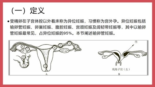 a0045 异位妊娠课件 第2页