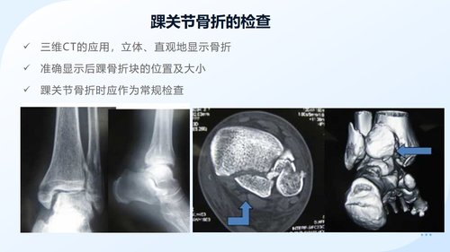 a0050 踝关节骨折围手术期护理 第2页