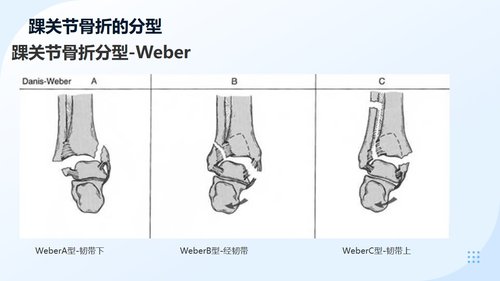 a0050 踝关节骨折围手术期护理 第3页