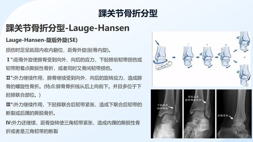 a0050 踝关节骨折围手术期护理 第4页