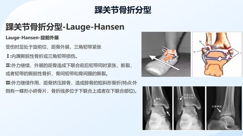 a0050 踝关节骨折围手术期护理 第5页