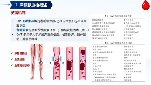 a0058 深静脉血栓预防与护理PPT课件33页可编辑无水印 第2页