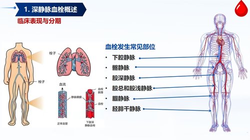 a0058 深静脉血栓预防与护理PPT课件33页可编辑无水印 第3页
