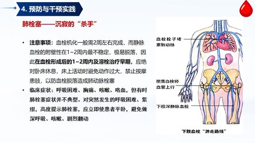 a0058 深静脉血栓预防与护理PPT课件33页可编辑无水印 第15页