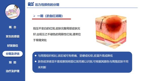 a0060 压力性损伤的预防及护理PPT课件21页可编辑无水印 第4页