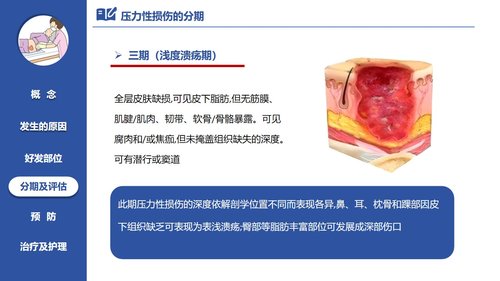 a0060 压力性损伤的预防及护理PPT课件21页可编辑无水印 第6页