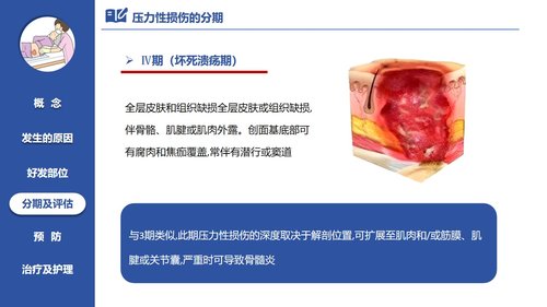 a0060 压力性损伤的预防及护理PPT课件21页可编辑无水印 第7页