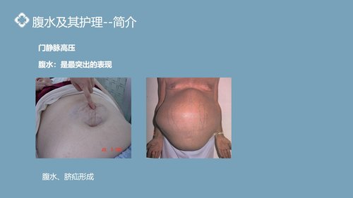 a0098 肝硬化腹水病人的护理PPT课件25页可编辑无水印 第6页