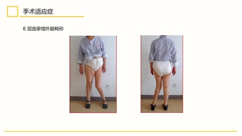 a0111 膝关节置换术后护理查房PPT课件30页可编辑无水印 第4页