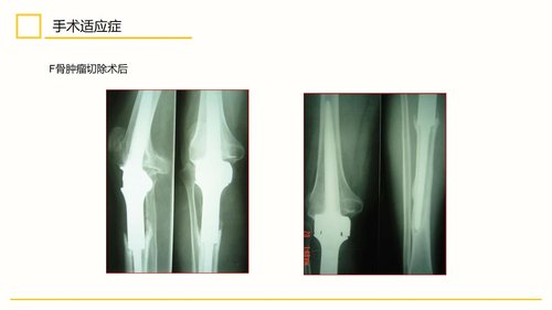 a0111 膝关节置换术后护理查房PPT课件30页可编辑无水印 第5页