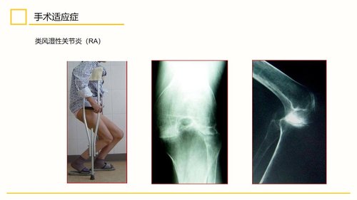 a0111 膝关节置换术后护理查房PPT课件30页可编辑无水印 第6页