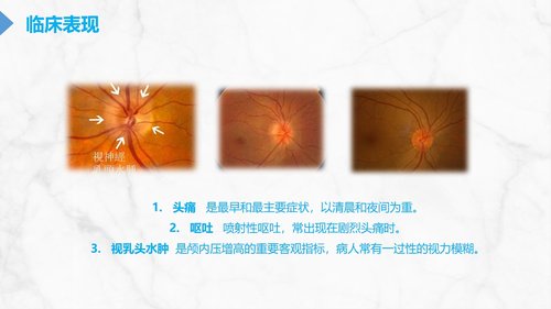 a0114 颅内压增高的护理PPT课件29页可编辑无水印 第3页