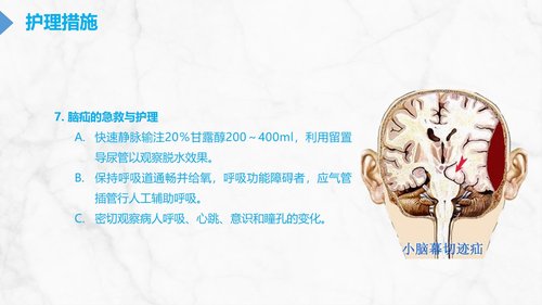 a0114 颅内压增高的护理PPT课件29页可编辑无水印 第11页