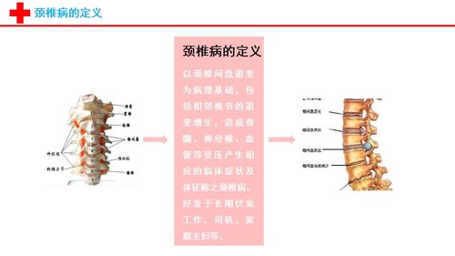 a0116 颈椎病的护理查房PPT课件22页可编辑无水印 第3页