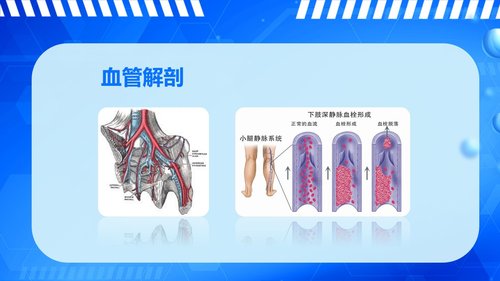 a0061 下肢深静脉血栓的护理查房PPT课件43页可编辑无水印 第3页