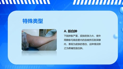 a0061 下肢深静脉血栓的护理查房PPT课件43页可编辑无水印 第7页
