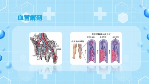 a0062 下肢静脉血栓的护理查房PPT课件43页可编辑无水印 第4页