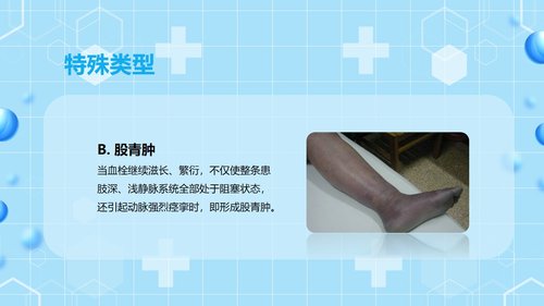 a0062 下肢静脉血栓的护理查房PPT课件43页可编辑无水印 第7页