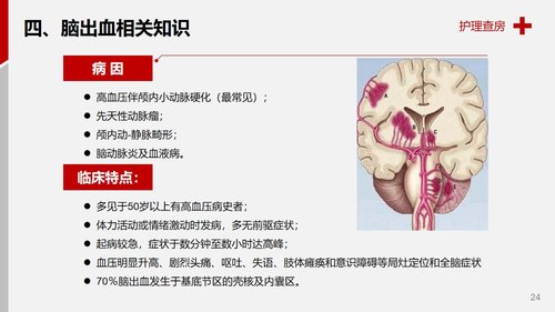 a0068 医学医疗护理查房脑出血案例分析PPT模板PPT课件28页可编辑无水印 第13页