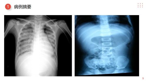 a0077 小儿肠套叠护理查房PPT课件25页可编辑无水印 第4页