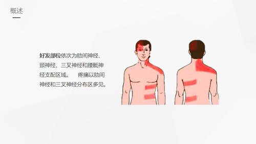 a0081 带状疱疹后遗神经痛护理课件PPT课件33页可编辑无水印 第4页