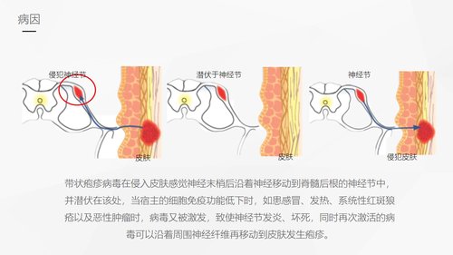 a0081 带状疱疹后遗神经痛护理课件PPT课件33页可编辑无水印 第5页