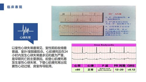 a0085 急性心肌梗死护理查房PPT课件31页可编辑无水印 第8页