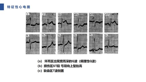 a0085 急性心肌梗死护理查房PPT课件31页可编辑无水印 第10页