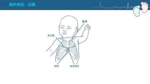 a0092 新生儿复苏CPR护理PPT课件84页可编辑无水印 第6页