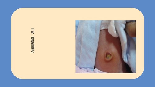 a0094 新生儿脐部护理PPT课件24页可编辑无水印 第12页
