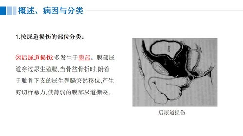 a0117 尿道损伤病人的护理PPT课件21页可编辑无水印 第3页