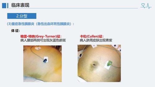 a0118 急性胰腺炎病人的护理PPT课件28页可编辑无水印 第10页