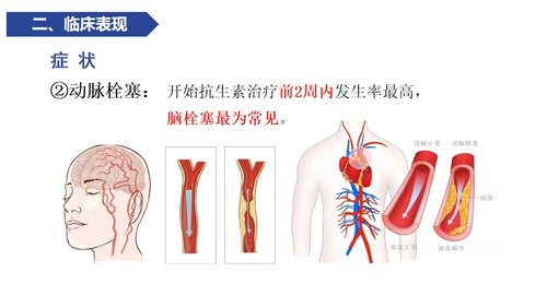 a0119 感染性心内膜炎病人的护理PPT课件21页可编辑无水印 第6页