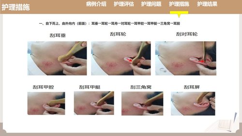 a0121 耳部全息铜砭刮痧联合耳尖放血在脑梗死介入取栓术后发热患者中的护理实践（33页）PPT课件33页可编辑无水印 第6页
