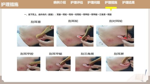 a0121 耳部全息铜砭刮痧联合耳尖放血在脑梗死介入取栓术后发热患者中的护理实践（33页）PPT课件33页可编辑无水印 第8页