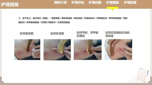 a0121 耳部全息铜砭刮痧联合耳尖放血在脑梗死介入取栓术后发热患者中的护理实践（33页）PPT课件33页可编辑无水印 第7页