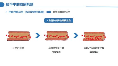 a0124 脑卒中病人的护理PPT课件30页可编辑无水印 第4页