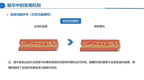 a0124 脑卒中病人的护理PPT课件30页可编辑无水印 第4页
