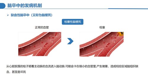a0124 脑卒中病人的护理PPT课件30页可编辑无水印 第6页