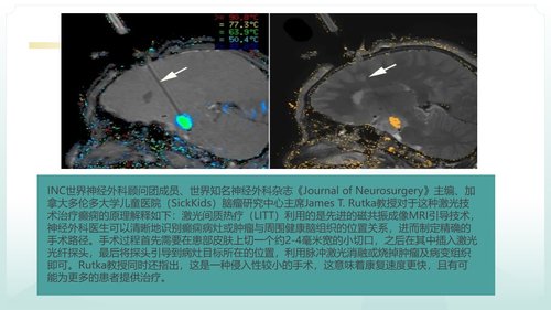 a0125 脑损伤激光间质热疗法PPT课件20页可编辑无水印 第9页