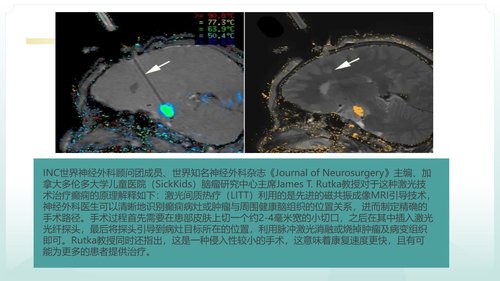 a0125 脑损伤激光间质热疗法PPT课件20页可编辑无水印 第12页
