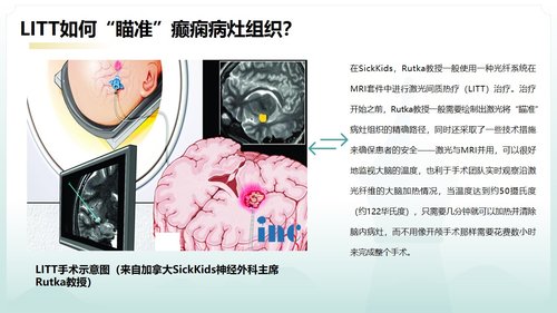 a0125 脑损伤激光间质热疗法PPT课件20页可编辑无水印 第13页