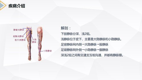 a0151 下肢静脉曲张的护理查房PPT课件30页可编辑无水印直接可用 第3页